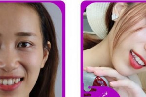 溫州拜博口腔醫(yī)院徐子卿整形價格表附牙齒隱形矯正案例展示