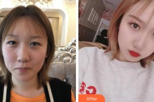 溫州醫(yī)科大學附屬眼視光醫(yī)院黃錦海整形價格表附切開雙眼皮案例展示