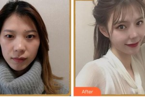 溫州醫(yī)科大學附屬眼視光醫(yī)院包芳軍整形價格表附眼部綜合案例展示