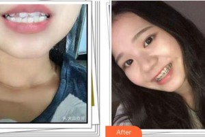 溫州拜博口腔醫(yī)院高振華整形價格表附冷光美白案例展示