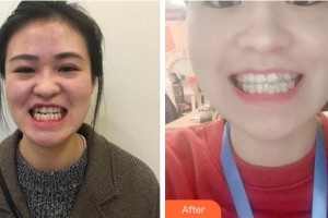 溫州牙博士口腔門診部魏謀達整形價格表附牙齒隱形矯正案例展示