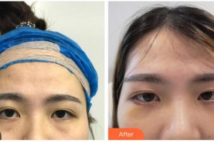 嘉興華山醫(yī)療美容醫(yī)院陳榮忠整形價格表附外切祛眼袋案例展示