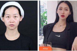 嘉興市第一醫(yī)院整形外科徐剛整形價格表附內(nèi)切祛眼袋案例展示