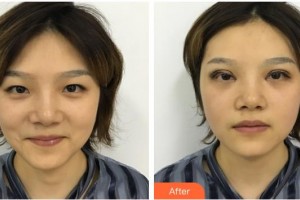 嘉興華山醫(yī)療美容醫(yī)院冉曉娟整形價格表附開內(nèi)眼角案例展示