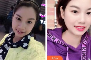 嘉興華山醫(yī)療美容醫(yī)院藍圓育整形價格表附金屬托槽矯正案例展示