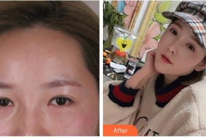 嘉興愛爾眼科醫(yī)院李文生整形價(jià)格表附眼部綜合案例展示