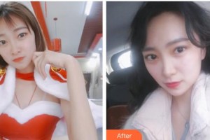 嘉興愛爾眼科醫(yī)院趙春會(huì)整形價(jià)格表附切開雙眼皮案例展示