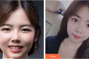 嘉興愛爾眼科醫(yī)院許正俊整形價(jià)格表附切開雙眼皮案例展示