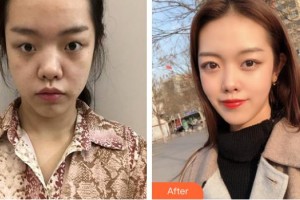 嘉興愛爾眼科醫(yī)院陳自淼整形價(jià)格表附切開雙眼皮案例展示