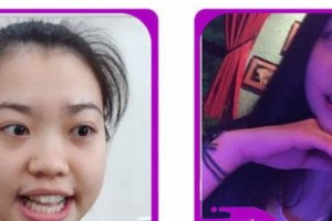 嘉興口腔醫(yī)院沈斌整形價(jià)格表附牙齒隱形矯正案例展示