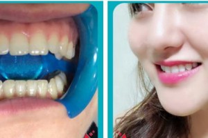 嘉興嘉誠口腔醫(yī)院谷丹整形價(jià)格表附冷光美白案例展示