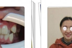 嘉興嘉誠口腔醫(yī)院苗華明整形價(jià)格表附金屬托槽矯正案例展示