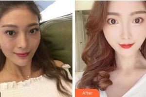 嘉興市中醫(yī)醫(yī)院眼科蔣麗君整形價(jià)格表附外切祛眼袋案例展示