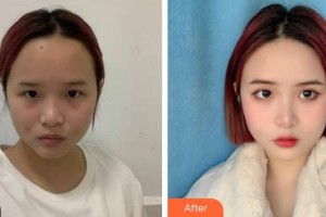 湖州曙光醫(yī)療美容門診部蘇恭敏整形價(jià)格表附激光祛斑案例展示