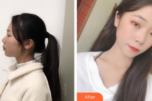 湖州曙光醫(yī)療美容門診部李倩整形價(jià)格表附美白嫩膚案例展示