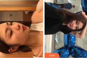 湖州同濟(jì)醫(yī)療美容門診部周敏珍整形價(jià)格表附光子嫩膚案例展示