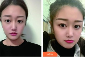 湖州心悅醫(yī)療美容門診部聶益軍整形價(jià)格表附埋線雙眼皮案例展示