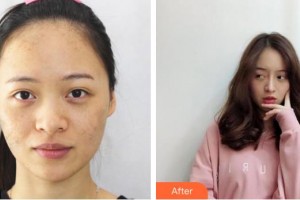 湖州尚麗醫(yī)療美容門診部宋君整形價(jià)格表附激光祛斑案例展示