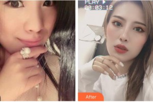 湖州長興愛爾眼科醫(yī)院童峰峰整形價(jià)格表附眼部綜合案例展示