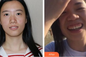 湖州金鉑利口腔門診部李光明整形價(jià)格表附隱形托槽矯正案例展示