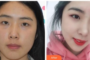 湖州愛爾眼科醫(yī)院丁慰祖整形價(jià)格表附激光去眼袋案例展示