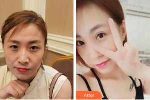 湖州愛爾眼科醫(yī)院唐劍波整形價(jià)格表附眼部綜合案例展示