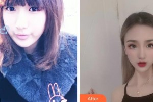 湖州愛爾眼科醫(yī)院沈旭良整形價(jià)格表附眼部綜合案例展示