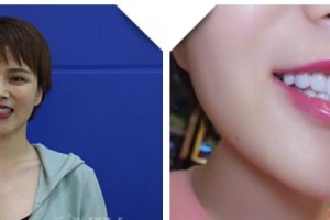 湖州鼎植口腔醫(yī)院詹傳華整形價(jià)格表附牙貼面案例展示