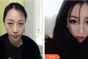 湖州長興愛爾眼科醫(yī)院楊晨皓整形價格表附激光去眼袋案例展示