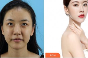 湖州長興愛爾眼科醫(yī)院高路整形價格表附開內(nèi)眼角案例展示