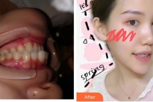 湖州溫馨口腔診所溫新鳳整形價格表附金屬托槽矯正案例展示