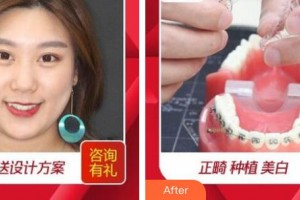 湖州溫馨口腔診所方云鶴整形價格表附隱形托槽矯正案例展示