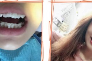 湖州陳景康牙科診所甘喜文整形價格表附牙齒陶瓷矯正案例展示