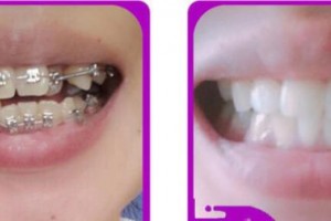 湖州陳景康牙科診所邰曉燕整形價格表附金屬托槽矯正案例展示