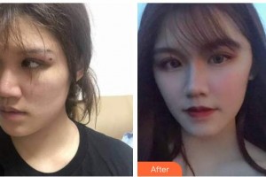 紹興華美整形美容醫(yī)院張潔整形價格表附埋線提升案例展示