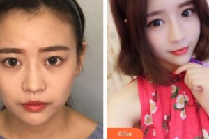 紹興華美整形美容醫(yī)院錢一佳整形價格表附熱瑪吉案例展示