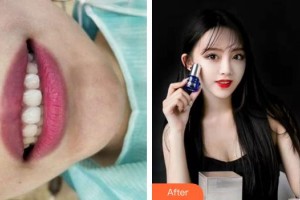 紹興華美整形美容醫(yī)院張佾科整形價格表附牙齒隱形矯正案例展示