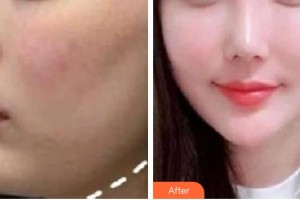 紹興華美整形美容醫(yī)院張賢期整形價格表附微針去頸紋案例展示