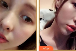 紹興市人民醫(yī)院醫(yī)療美容科徐永根整形價格表附眼鼻部手術案例展示