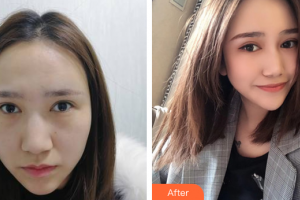 深圳美度醫(yī)療美容醫(yī)院朱凱整形價(jià)格表附去眼袋淚溝案例展示