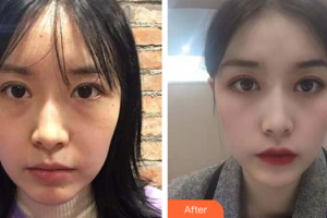 深圳美度醫(yī)療美容醫(yī)院劉玲住院醫(yī)師整形價(jià)格表附眼修復(fù)案例展示