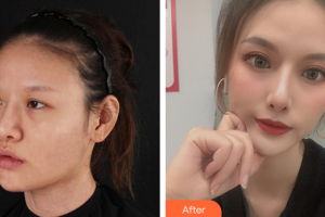 深圳美源醫(yī)療美容門診部吳曉玲整形價(jià)格表附眼部整形案例展示