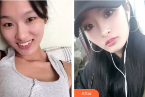 深圳賀五洲醫(yī)療美容診所胡開賢整形價(jià)格表附鼻部手術(shù)案例展示