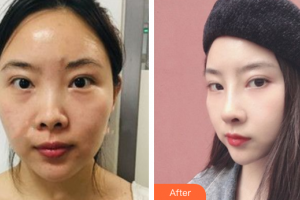 深圳美芮（原雅唯）醫(yī)療美容門診部夏超整形價(jià)格表附鼻部手術(shù)案例展示