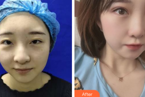 深圳美芮（原雅唯）醫(yī)療美容門診部曹琛整形價(jià)格表附雙眼皮案例展示