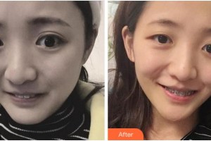 紹興柯橋口腔醫(yī)院宋閑整形價格表附金屬托槽矯正案例展示