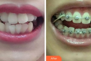 紹興博雅口腔醫(yī)院何章良整形價格表附金屬托槽矯正案例展示