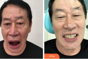 紹興博雅口腔醫(yī)院金燦新整形價格表附種植牙案例展示