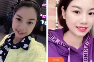 紹興博雅口腔醫(yī)院酈興整形價(jià)格表附金屬托槽矯正案例展示