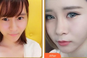 紹興愛爾眼科醫(yī)院王勝利整形價(jià)格表附眼部綜合案例展示